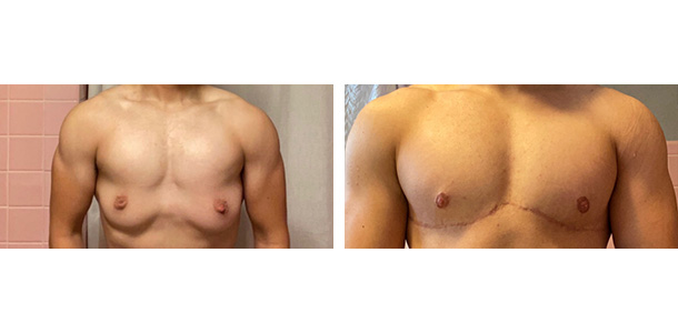 AFAB-Masculoplasty-04