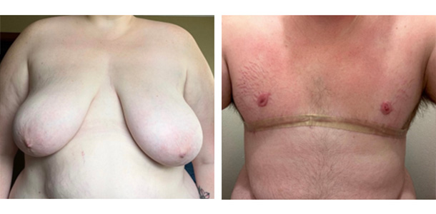 AFAB-Masculoplasty-05