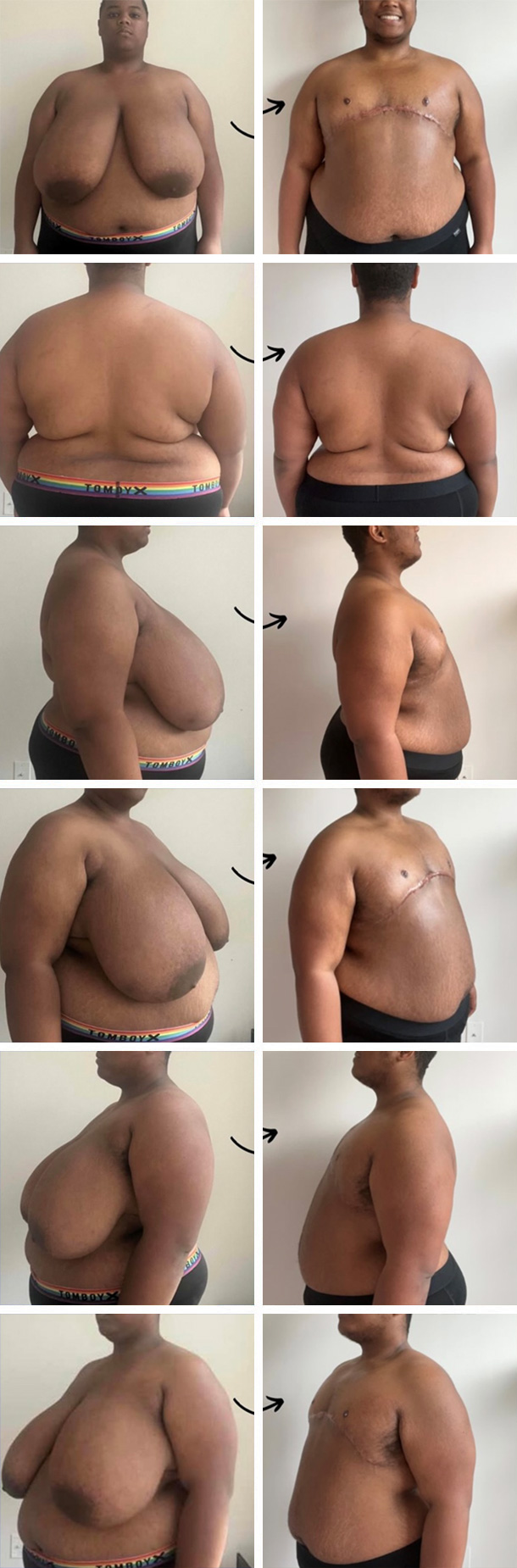 AFAB-Masculoplasty-07