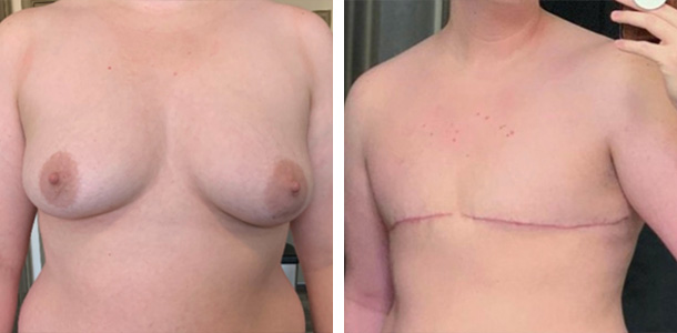 AFAB-Masculoplasty-10