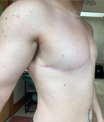 AFAB-Masculoplasty-12