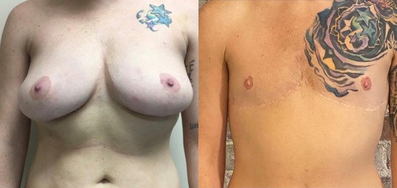 AFAB-Masculoplasty-13