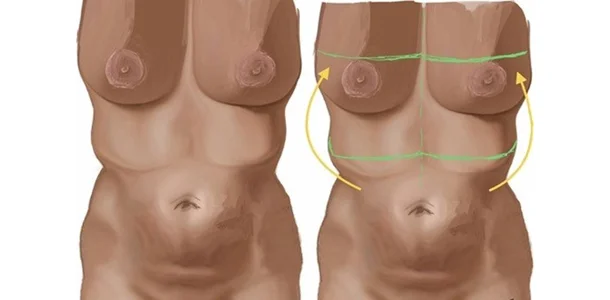 AFAB-Masculoplasty-Plus-2