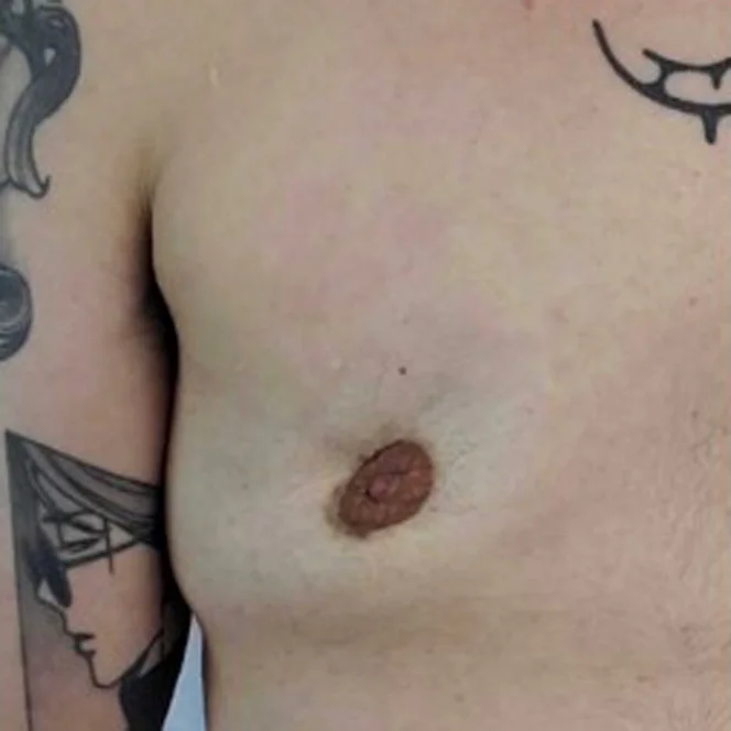 AFAB-Top-Surgery-Revisions-1