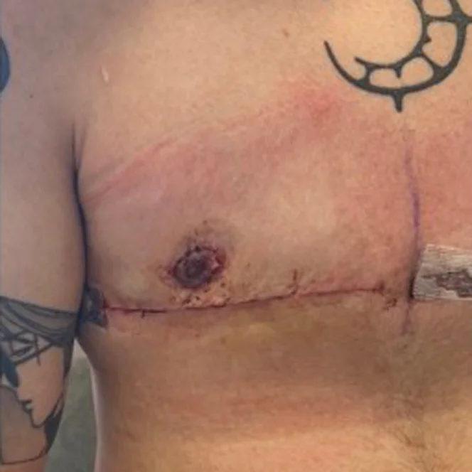 AFAB-Top-Surgery-Revisions-2