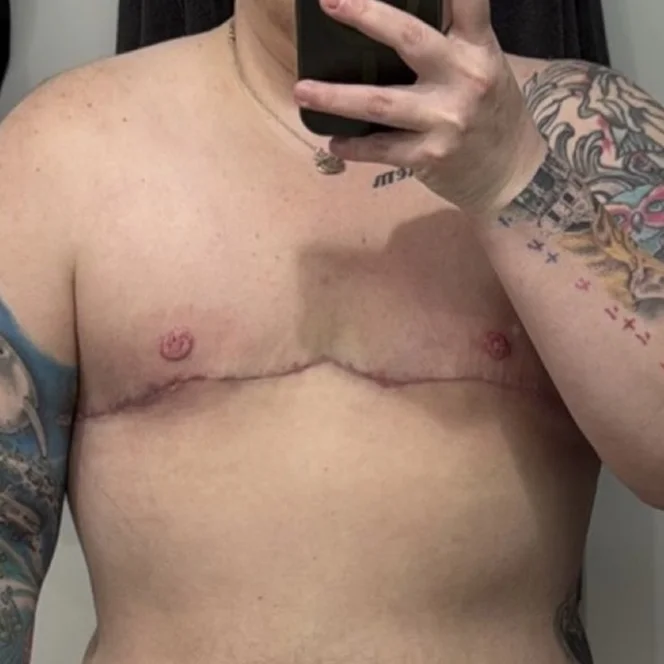 AFAB-Top-Surgery-Revisions-4