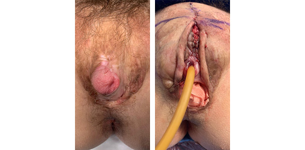 Bottom-Surgery-Revisions-01