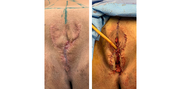 Bottom-Surgery-Revisions-02