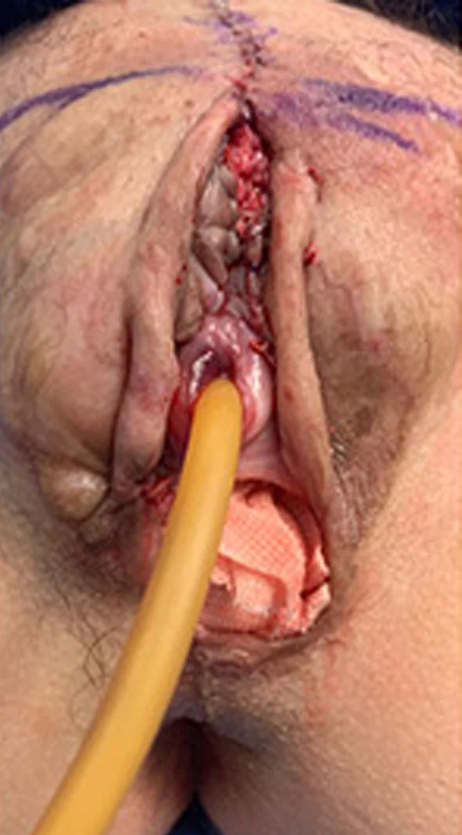 Bottom-Surgery-Revisions-2