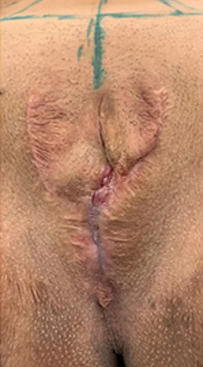 Bottom-Surgery-Revisions-3