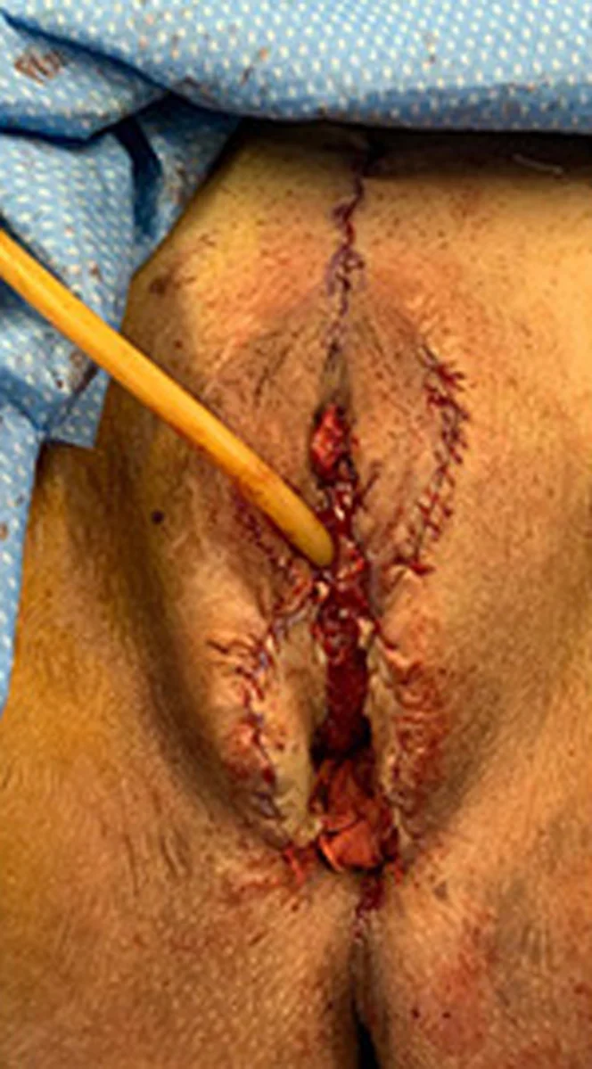 Bottom-Surgery-Revisions-4