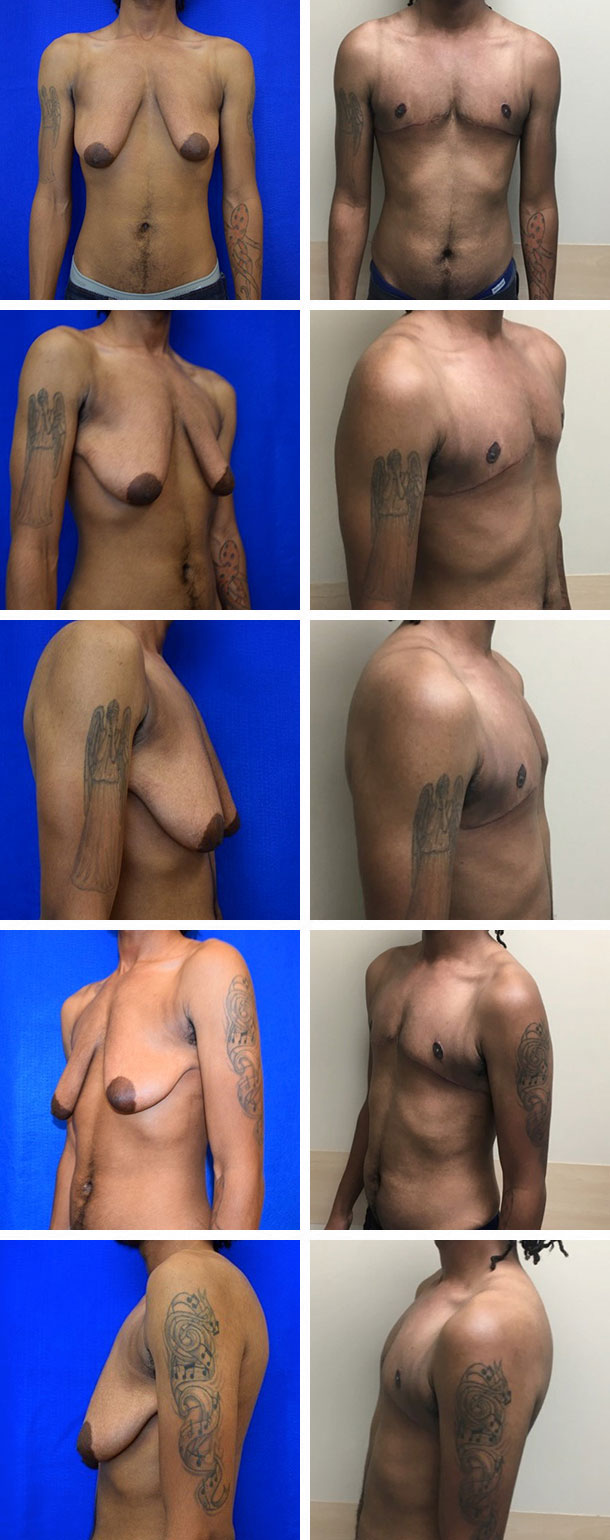 FTM-Masculoplasty-001