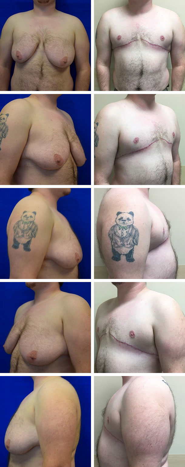 FTM-Masculoplasty-003