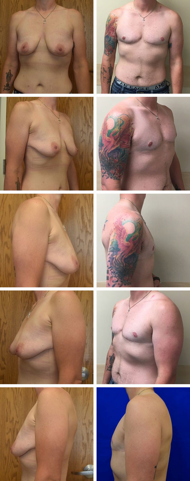 FTM-Masculoplasty-004