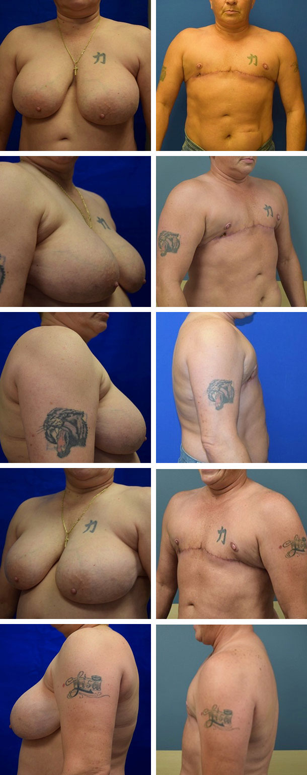 FTM-Masculoplasty-006