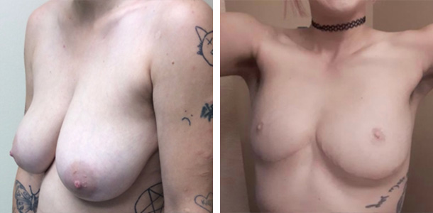 Non-Flat-Top-Surgery-02