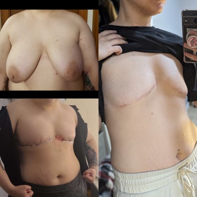 Non-Flat-Top-Surgery-04