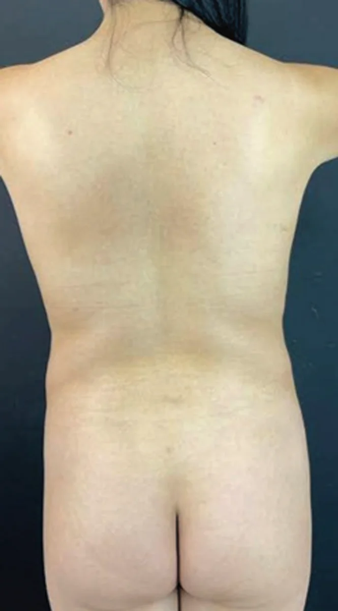 Rib Remodeling wRibxcar technique-1