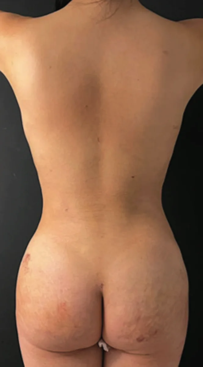 Rib Remodeling wRibxcar technique-2