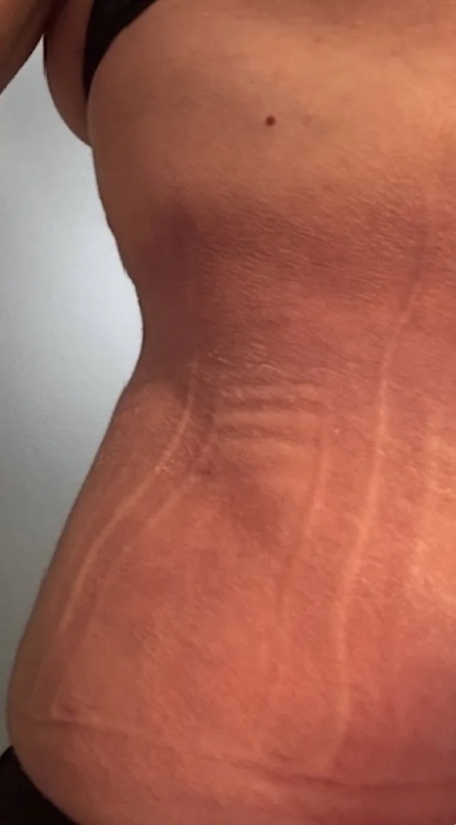 Rib Remodeling wRibxcar technique-4