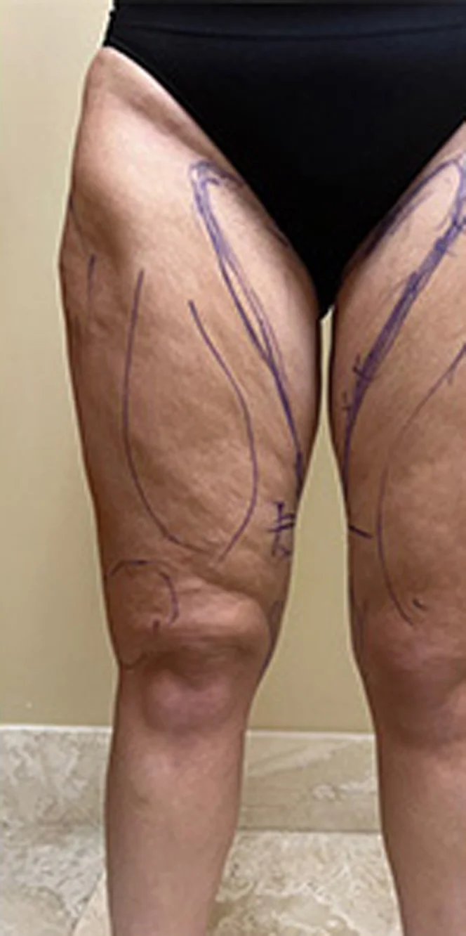 Thigh-Lift-and-Liposuction-1