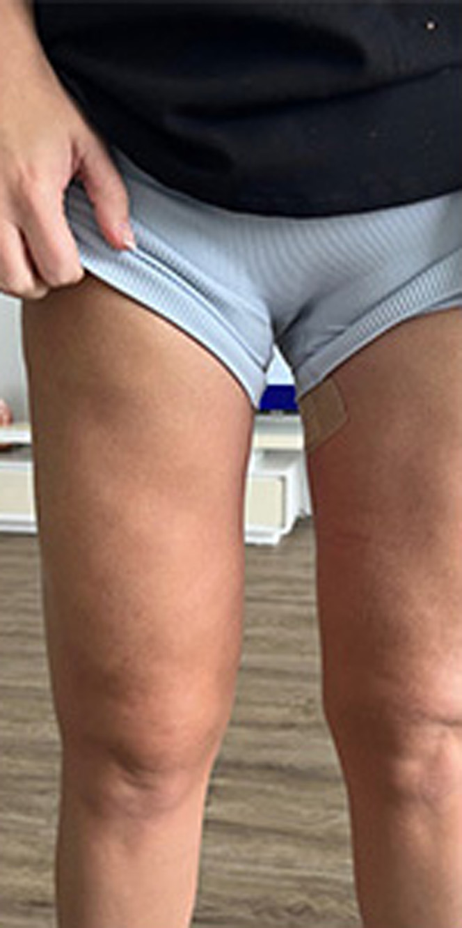 Thigh-Lift-and-Liposuction-2