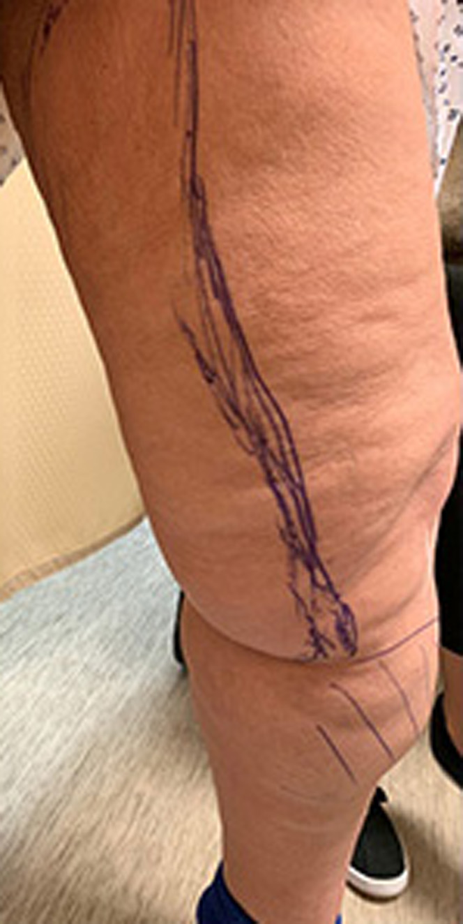 Thigh-Lift-and-Liposuction-3