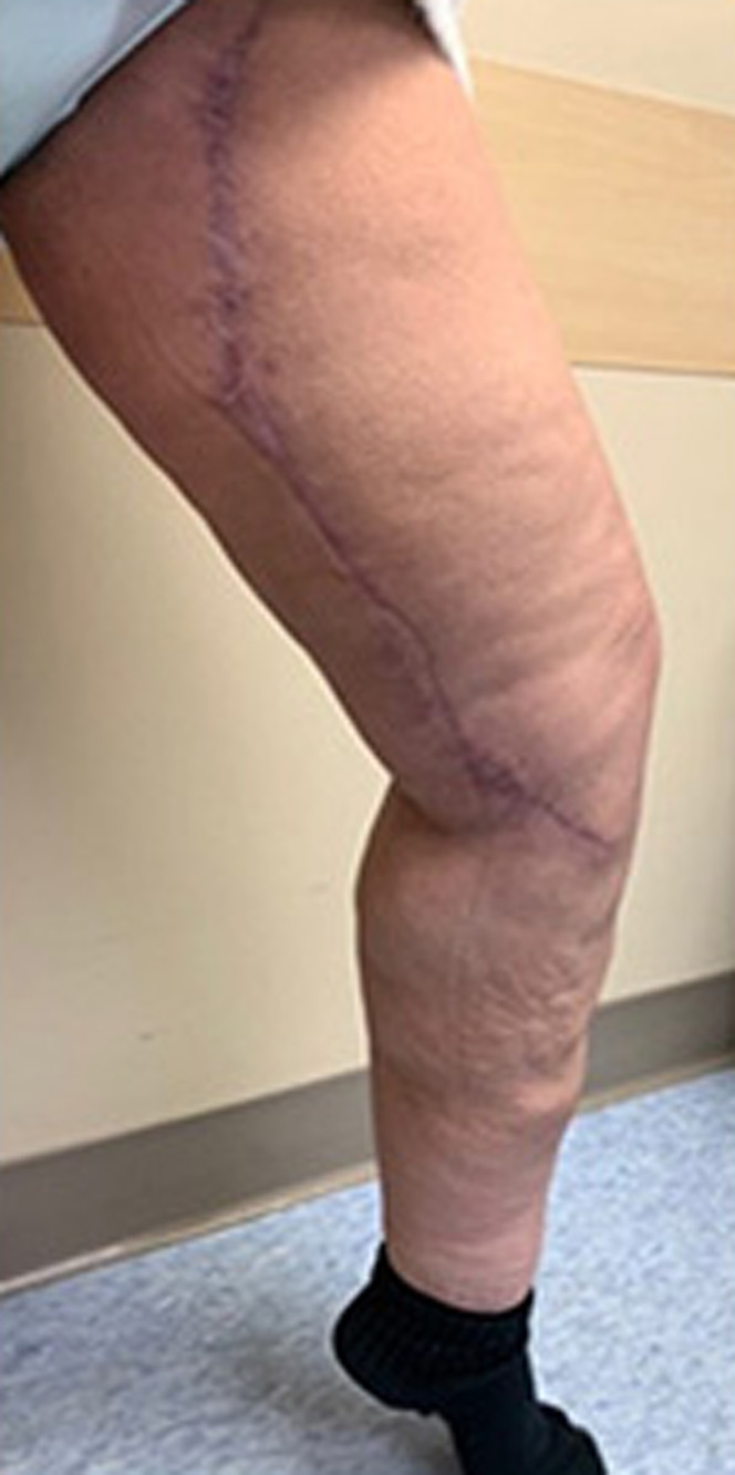 Thigh-Lift-and-Liposuction-4