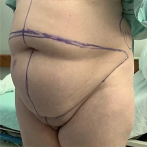 abdominoplasty-1