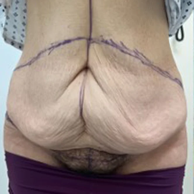 abdominoplasty-3
