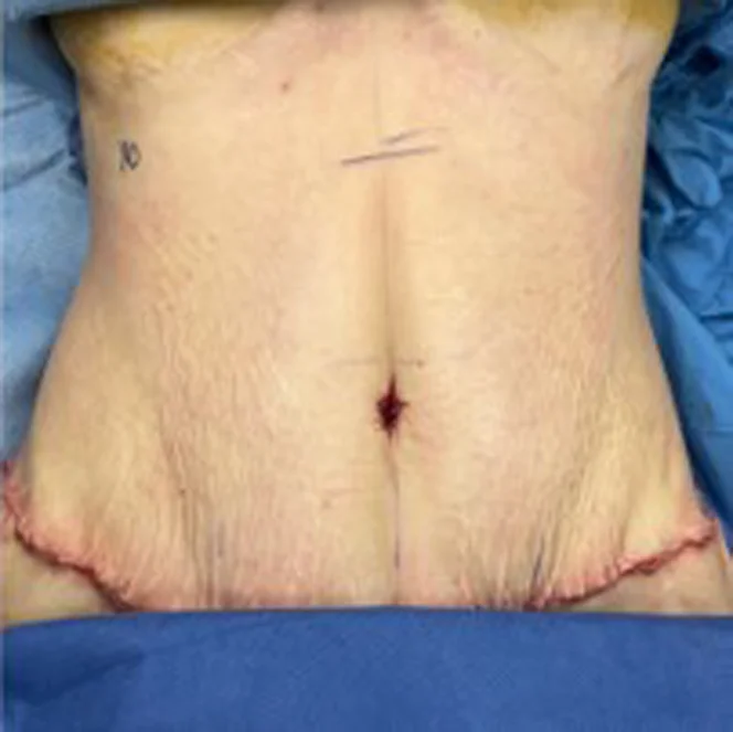 abdominoplasty-4