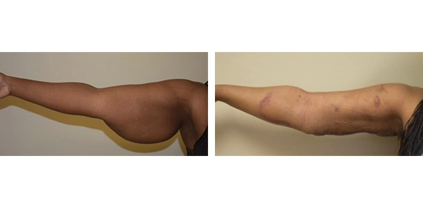 arm-lift-and-liposuction-01