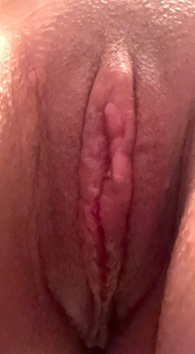 clitoris reduction-2