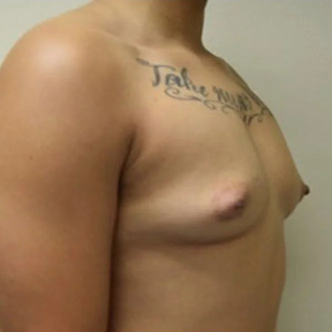 keyhole-mastectomy-1