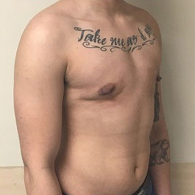 keyhole-mastectomy-2