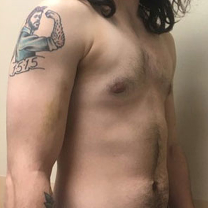 keyhole-mastectomy-4