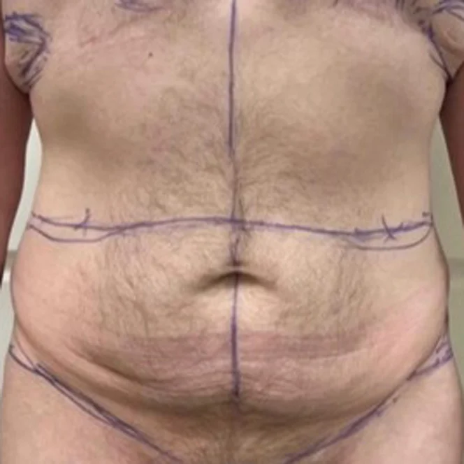 masculinizing-tummy-tuck-1