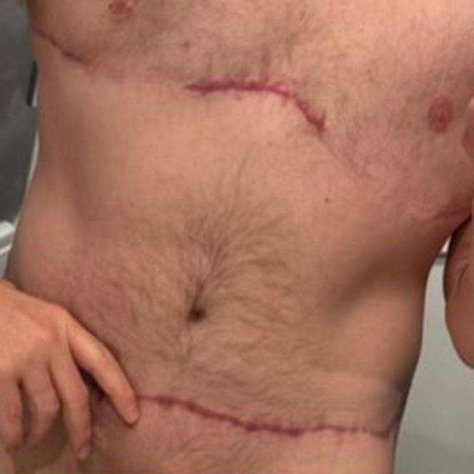 masculinizing-tummy-tuck-2