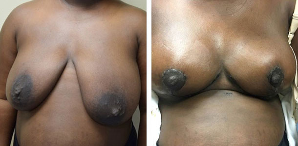 oncoplastic-reduction-001