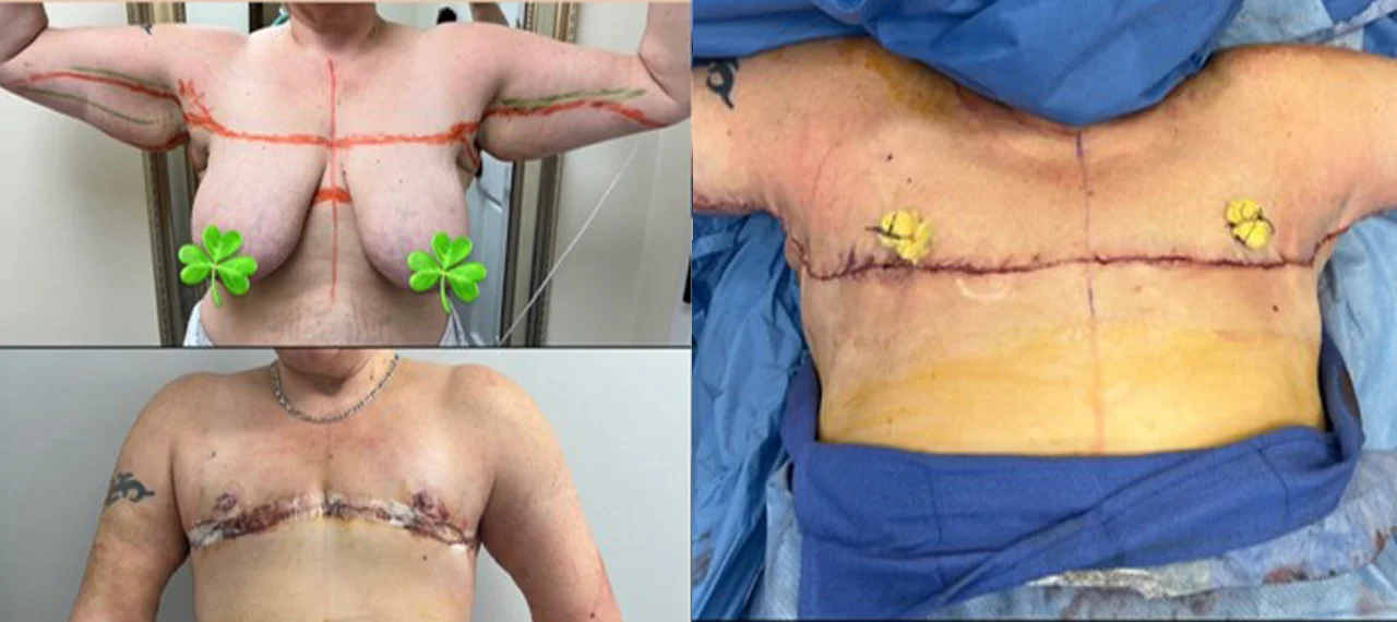 top and arm surgery-1