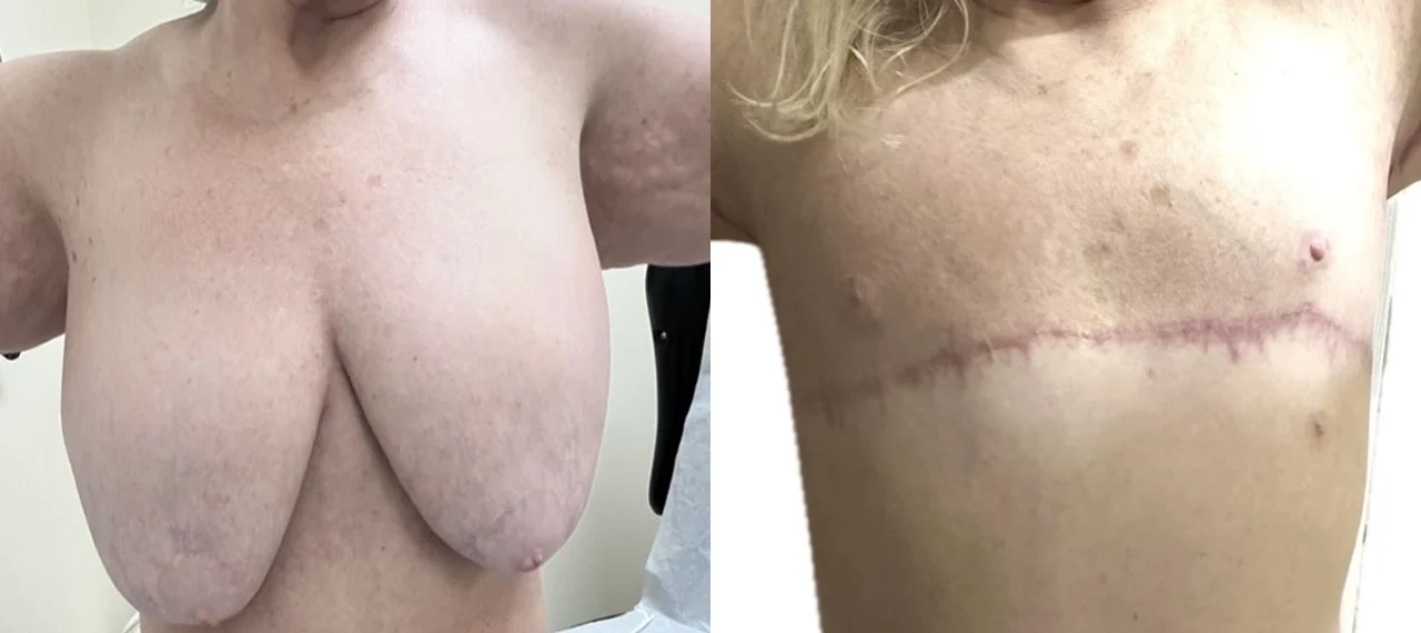 top and arm surgery-2