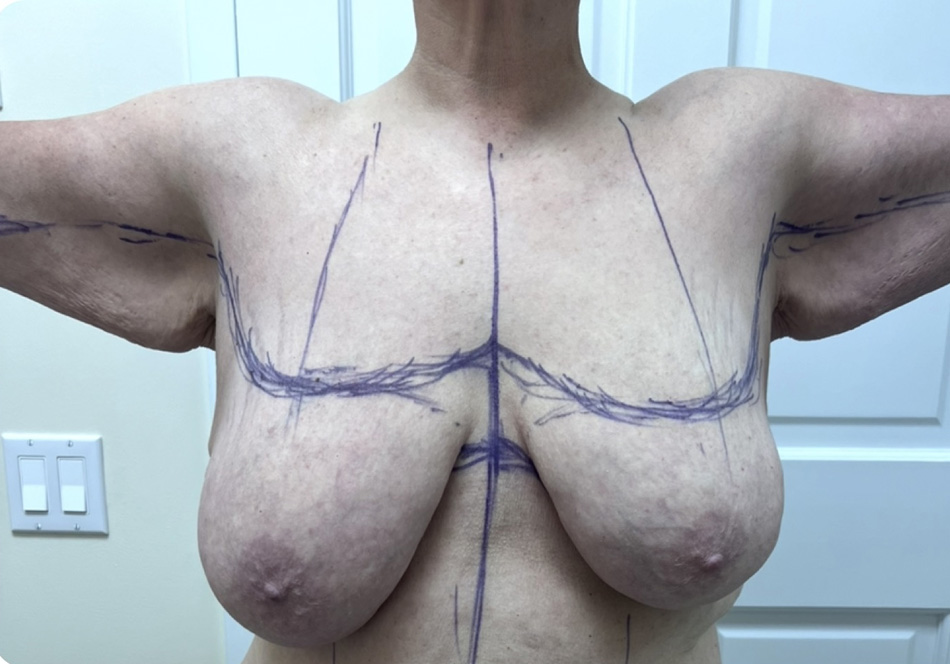 top surg & arm lift-1