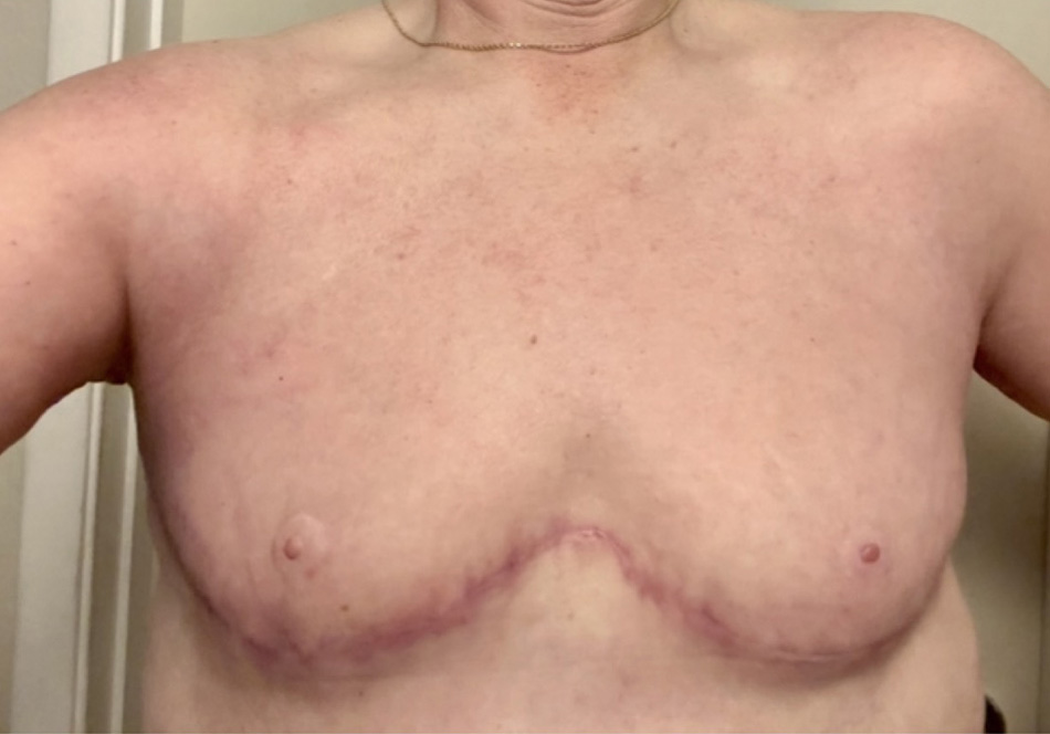 top surg & arm lift-2