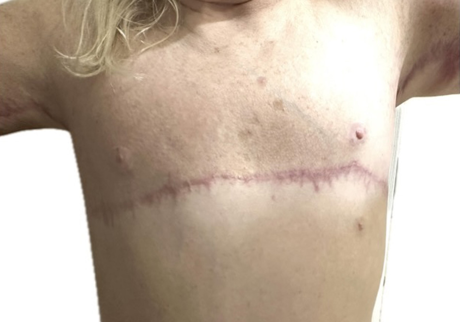 top surg & arm lift-4