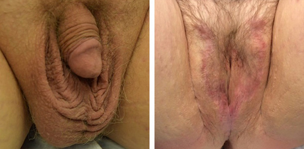 vaginoplasty-005