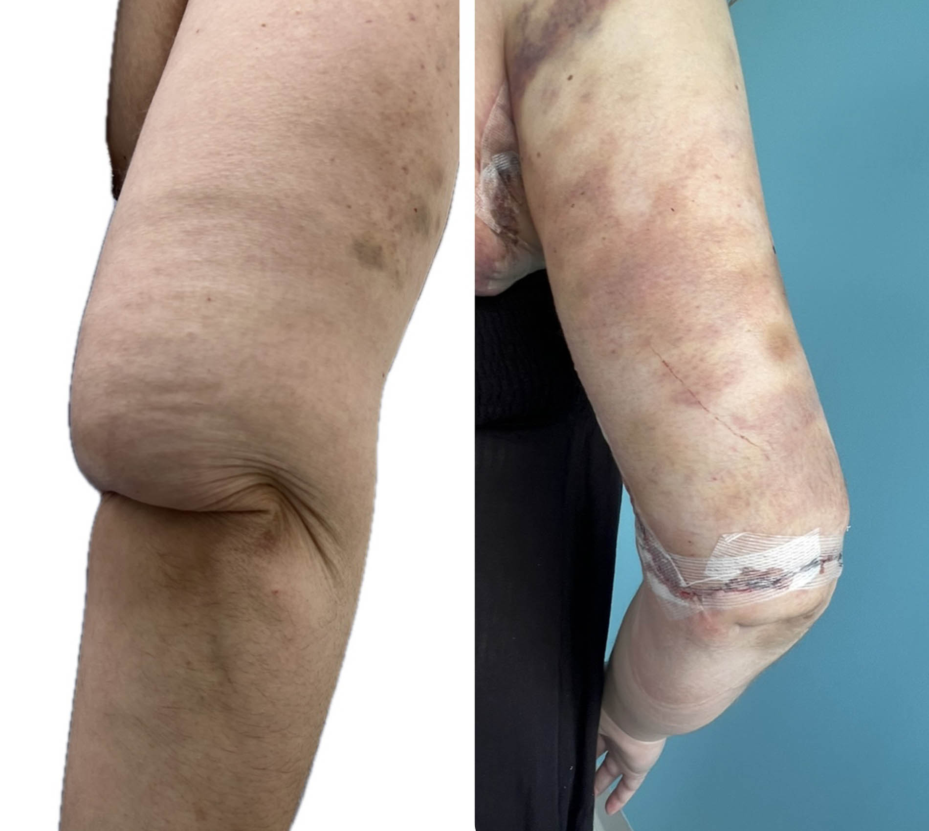 1_0001_elbow lift 2.JPG