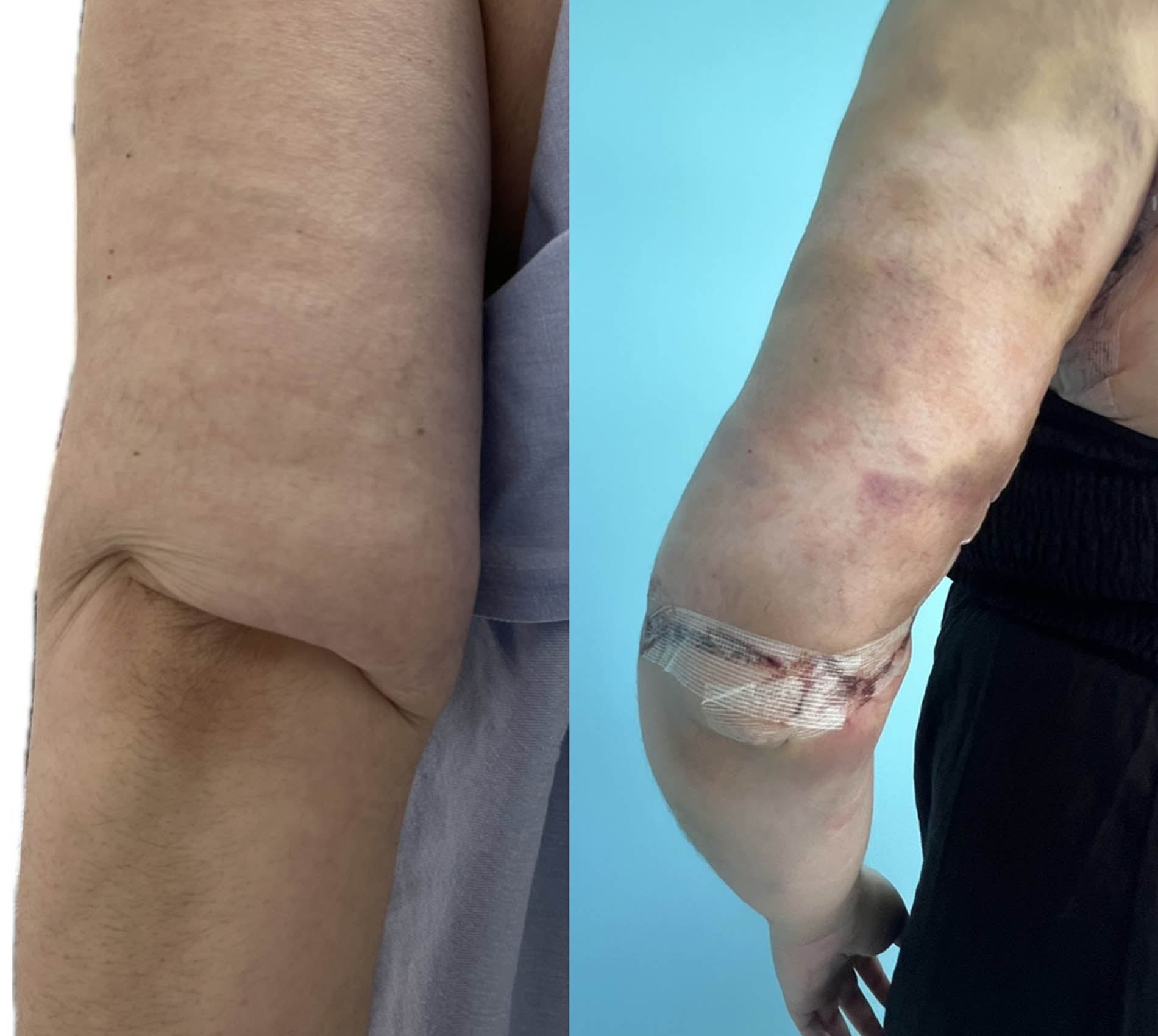 1_0002_elbow lift 3.JPG