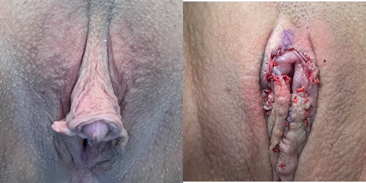 Clitoris reduction immediate