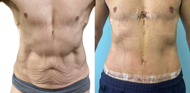 abdominoplasty 1.JPG