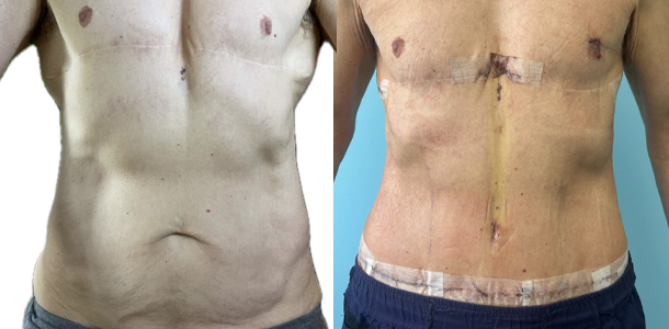 abdominoplasty 2.JPG